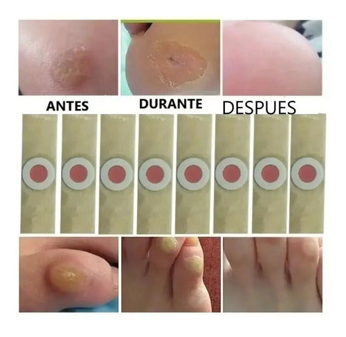Kit De 12 Parches Quita Callos, Verrugas, Ojo De Pez