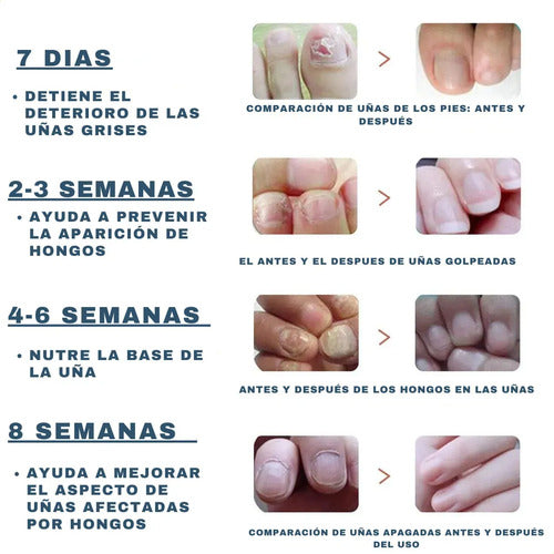 Parches Cuidado De Uñas Amarillas Cura Casera Para Hongos